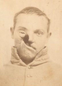 Union Soldier Carlton Burgan, Whose Upper Mouth, Palate, Right Cheek, and Right Eye Were Effected by Calomel Poisoning, courtesy National Museum of Medicine and Health